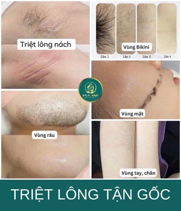 Tổng hợp kết quả triệt lông tận gốc tại Hoa Anh — nách, bikini, mặt, râu